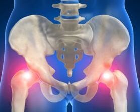 causes of hip arthrosis