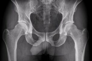 possibilities of diagnosis of hip arthrosis