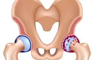 stages of development of hip arthrosis