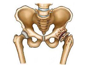 what is hip arthrosis