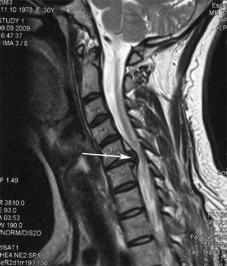 Damage to the spinal cord causes neck pain