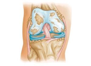 damage to the knee joint by osteoarthritis