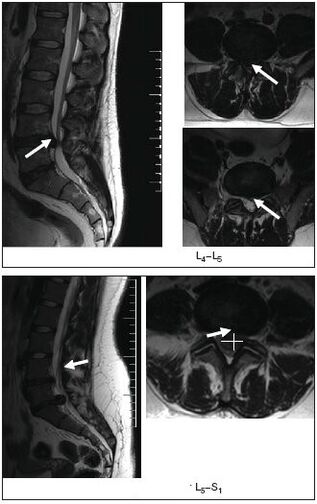 MRI scan of spinal disc herniation