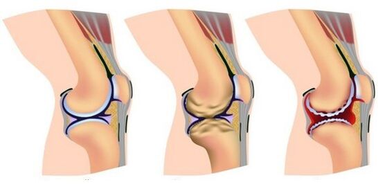 healthy joint and pain in knee joint destruction