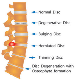 various damaged disc of the spine